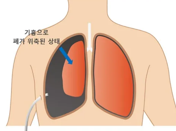 기흉 응급 처치 가이드 – 원인, 증상, 치료 방법