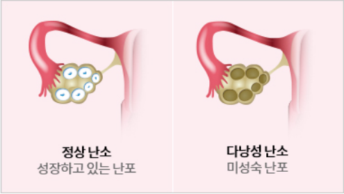 다난성 난소증후군 증상과 치료 여성 건강 가이드